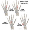 3rd metacarpal fracture splint 3rd metacarpal fracture splint