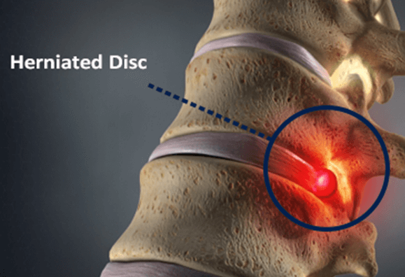 Is Herniated Disk Surgery Dangerous