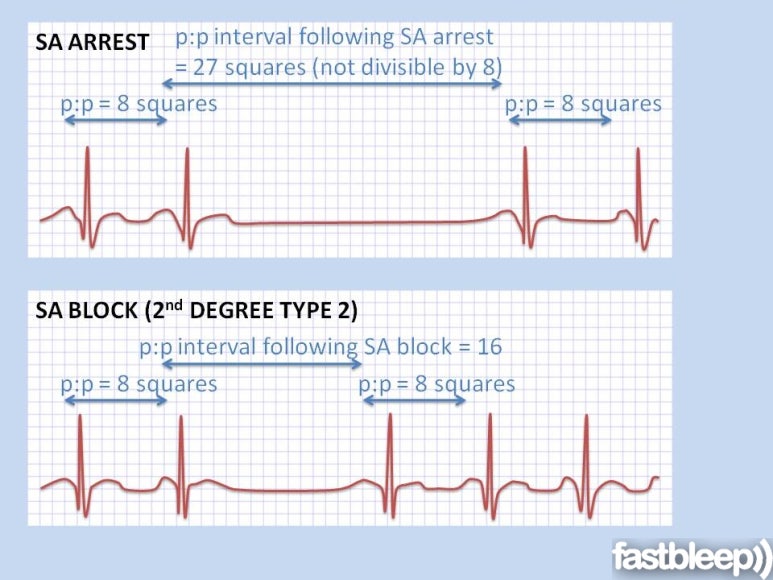Bradyarrhytmia Tachyarrhythmia EAD DAD SA Node Dysfunction figure-031-3152-electrocardiography-ecg-of-a-patient-with-sinus-node