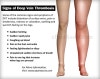 열정♡임상: 심부정맥 혈전증[DVT - Deep Vein Thrombosis] [D-dimer] : 네이버 블로그