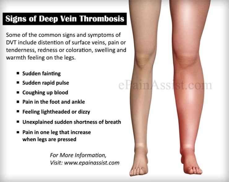 dvt-deep-vein-thrombosis-d-dimer