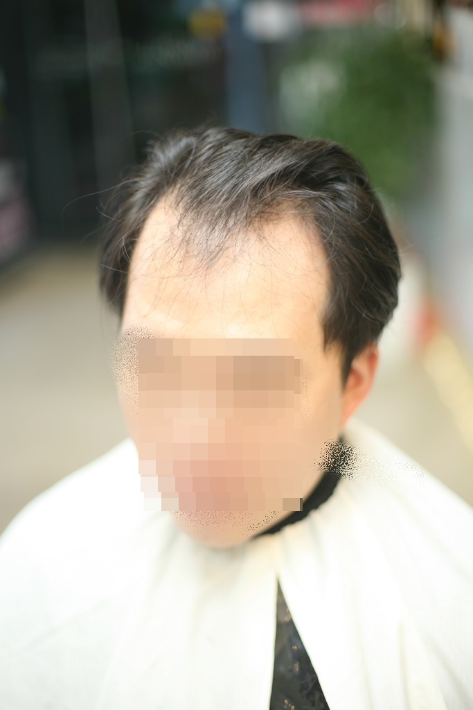 창원 M자 탈모 남자 헤어스타일 이렇게 달라졌어요 : 네이버 블로그